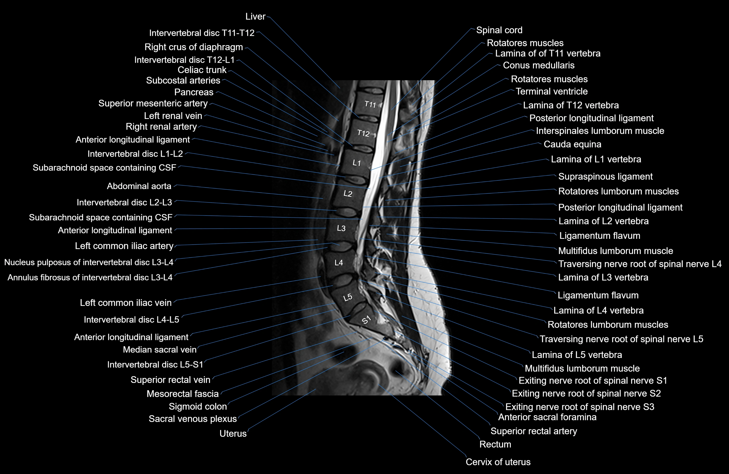 MRI lumbar spine sagittal cross sectional anatomy 3T radiology  image-img-00001-00016.webp